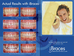actual ibraces results